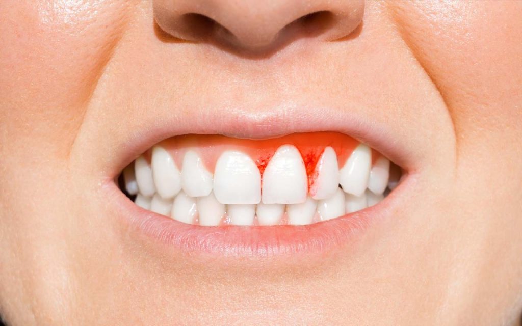 dépistage gingivite Montréal