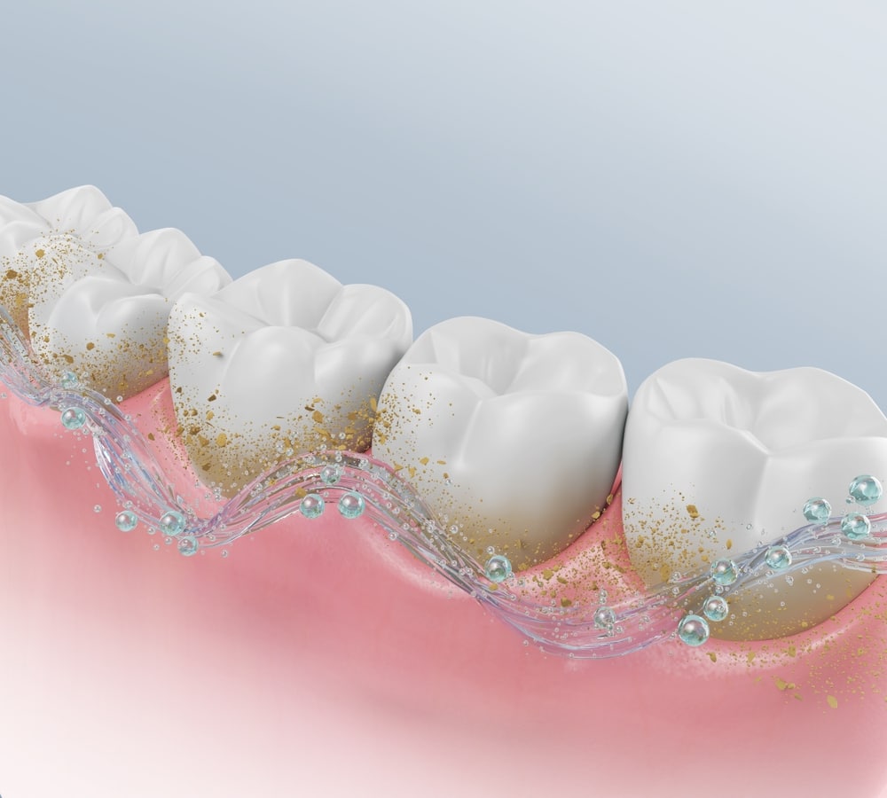 prévention caries Montréal.